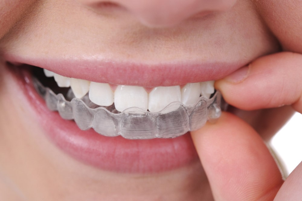 Gouttières Invisalign