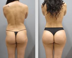 Liposuccion, Abdominoplastie & Brazilian Butt Lift (BBL)