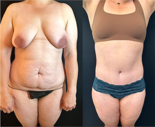 Liposuccion, Abdominoplastie & Plastie Mammaire sans prothèse