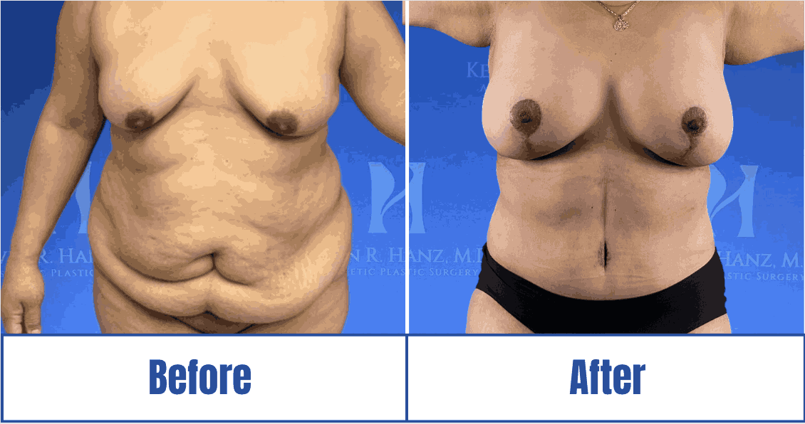 Liposuccion, Abdominoplastie, Plastie Mammaire sans prothèse & BBL