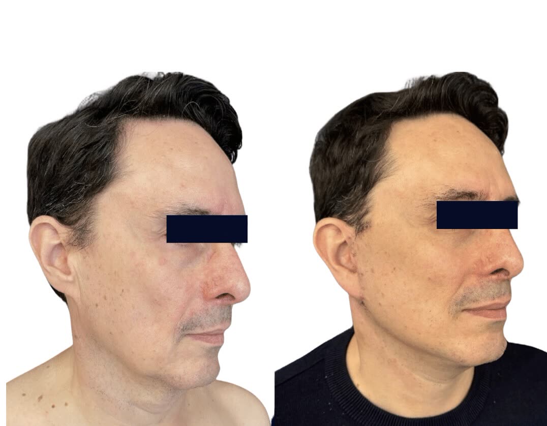 Lifting Cervico-Facial