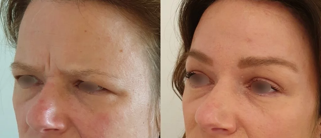 Lifting Frontal