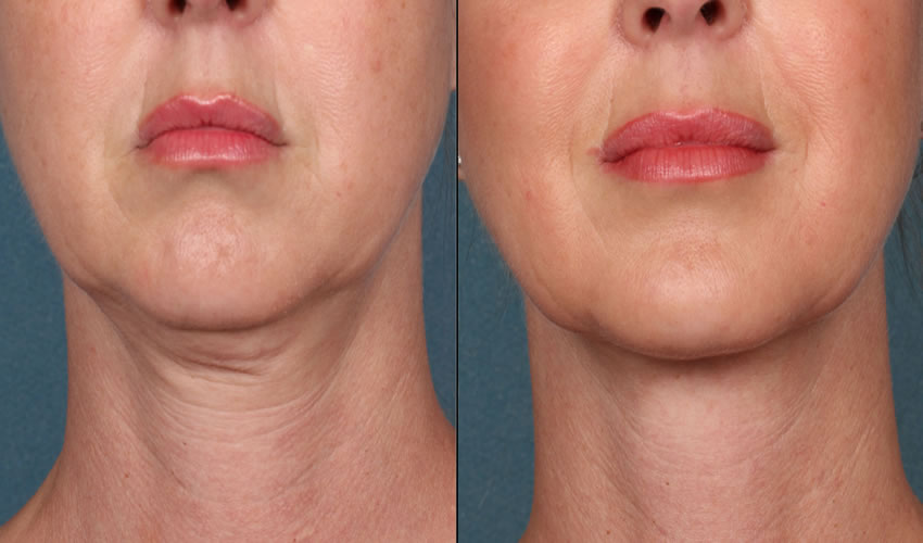 SmartLipo Menton