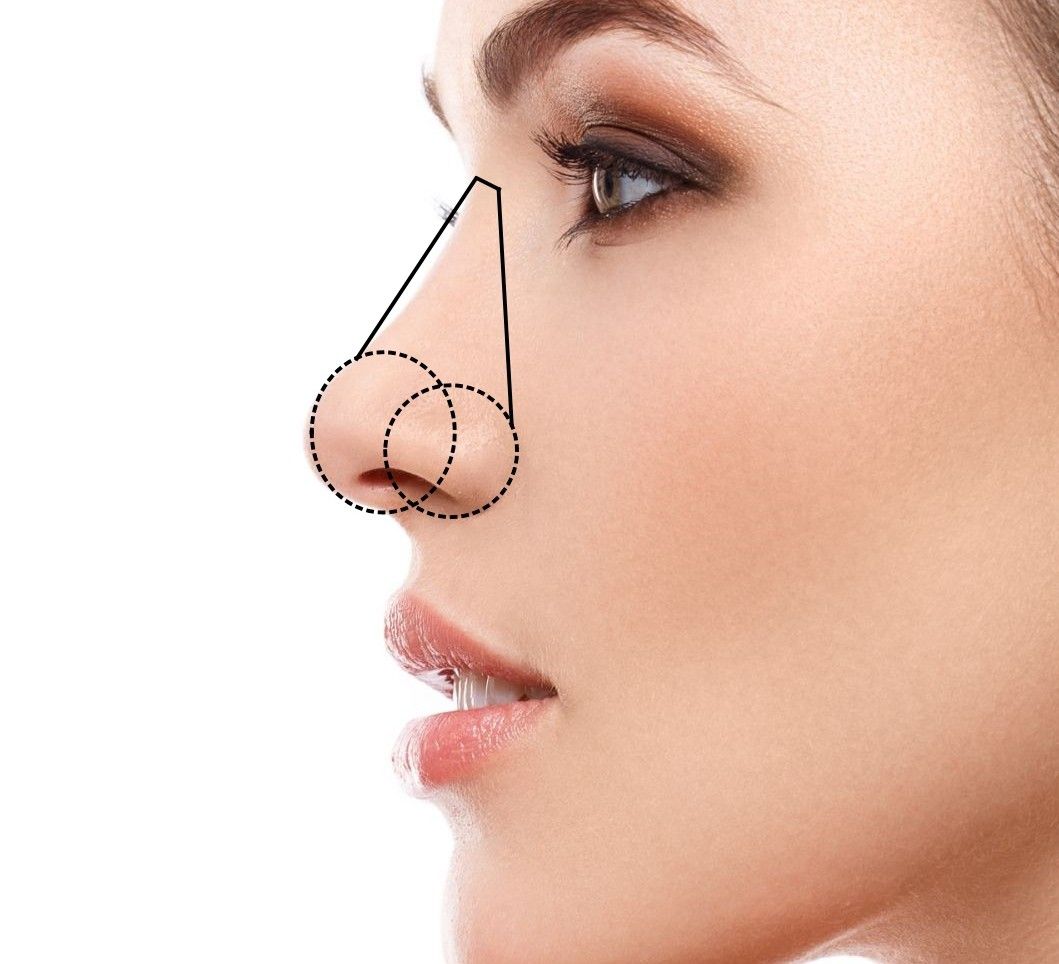 Rhinoplastie Ultrasonique