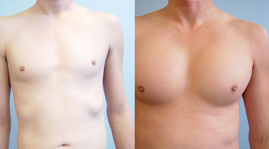 Implants Pectoraux