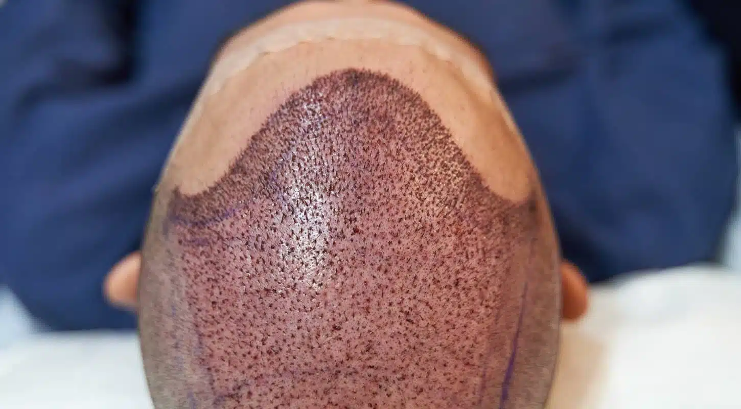 Hair Transplant